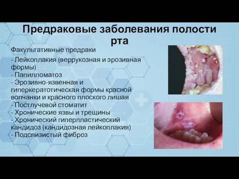 Предраковые заболевания полости рта Факультативные предраки - Лейкоплакия (веррукозная и эрозивная формы)