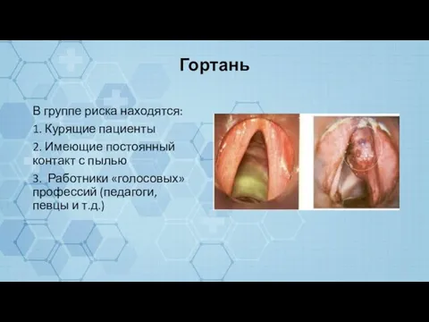 Гортань В группе риска находятся: 1. Курящие пациенты 2. Имеющие постоянный контакт