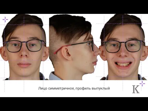 Лицо симметричное, профиль выпуклый