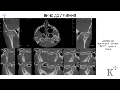 ВНЧС ДО ЛЕЧЕНИЯ Дистальное положение головок ВНЧС справа и слева.
