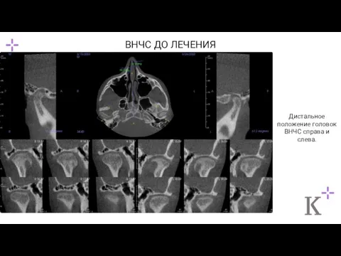 ВНЧС ДО ЛЕЧЕНИЯ Дистальное положение головок ВНЧС справа и слева.