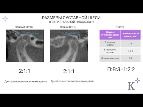 РАЗМЕРЫ СУСТАВНОЙ ЩЕЛИ В САГИТТАЛЬНОЙ ПЛОСКОСТИ Правый ВНЧС Левый ВНЧС 2:1:1 2:1:1