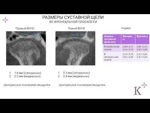 РАЗМЕРЫ СУСТАВНОЙ ЩЕЛИ ВО ФРОНТАЛЬНОЙ ПЛОСКОСТИ Правый ВНЧС Левый ВНЧС 1.8 мм