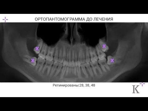 ОРТОПАНТОМОГРАММА ДО ЛЕЧЕНИЯ Ретинированы:28, 38, 48