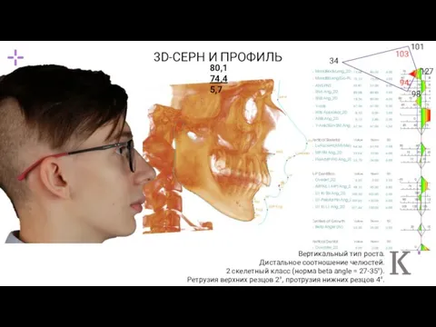 Вертикальный тип роста. Дистальное соотношение челюстей. 2 скелетный класс (норма beta angle