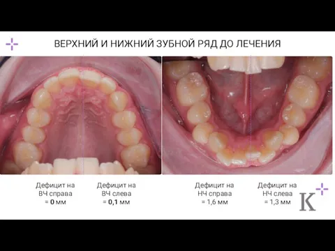 ВЕРХНИЙ И НИЖНИЙ ЗУБНОЙ РЯД ДО ЛЕЧЕНИЯ Дефицит на ВЧ справа =