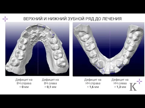 ВЕРХНИЙ И НИЖНИЙ ЗУБНОЙ РЯД ДО ЛЕЧЕНИЯ Дефицит на ВЧ справа =