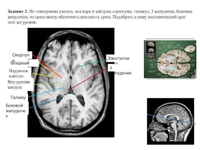 Задание 2. На томограмме указать: все ядра и капсулы стриатума, таламус, 3