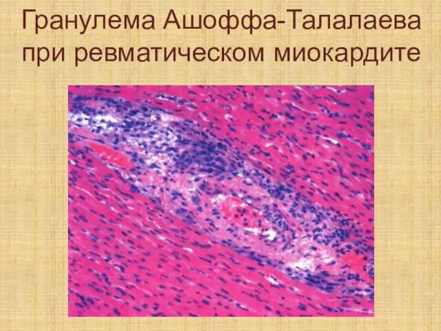 Гранулема Ашоффа-Талалаева при ревматическом миокардите