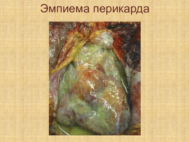 Эмпиема перикарда