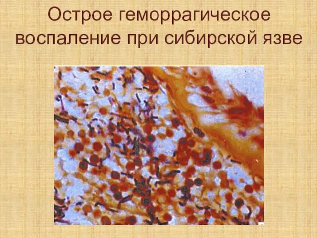 Острое геморрагическое воспаление при сибирской язве