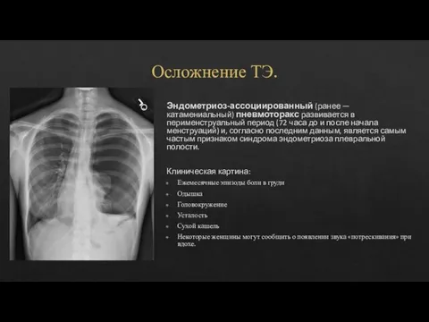 Осложнение ТЭ. Эндометриоз-ассоциированный (ранее — катамениальный) пневмоторакс развивается в перименструальный период (72