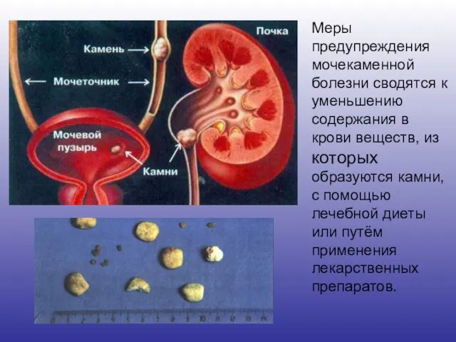 Меры предупреждения мочекаменной болезни сводятся к уменьшению содержания в крови веществ, из