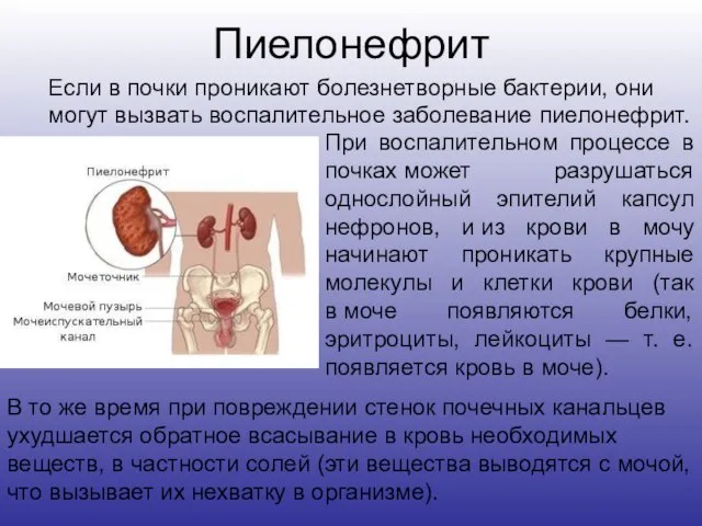 Пиелонефрит Если в почки проникают болезнетворные бактерии, они могут вызвать воспалительное заболевание