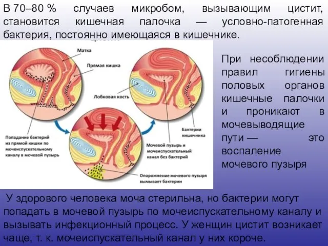 В 70–80 % случаев микробом, вызывающим цистит, становится кишечная палочка — условно-патогенная