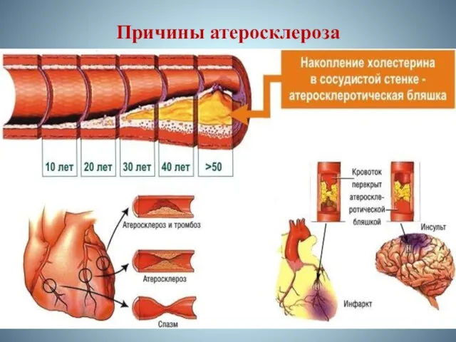 Причины атеросклероза