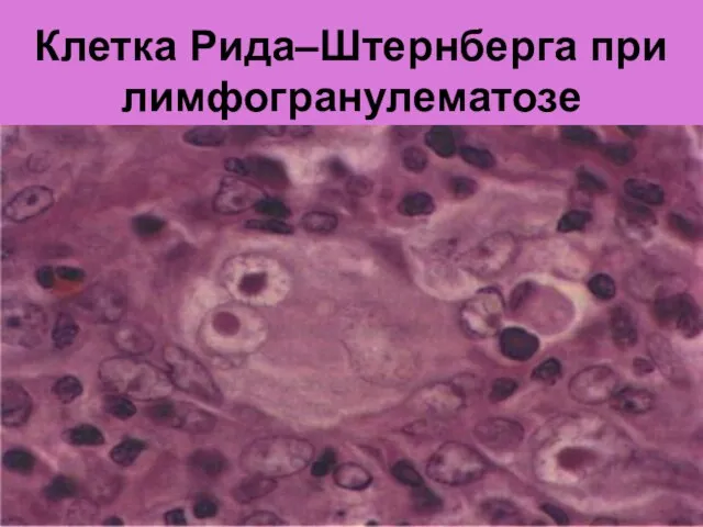 Клетка Рида–Штернберга при лимфогранулематозе