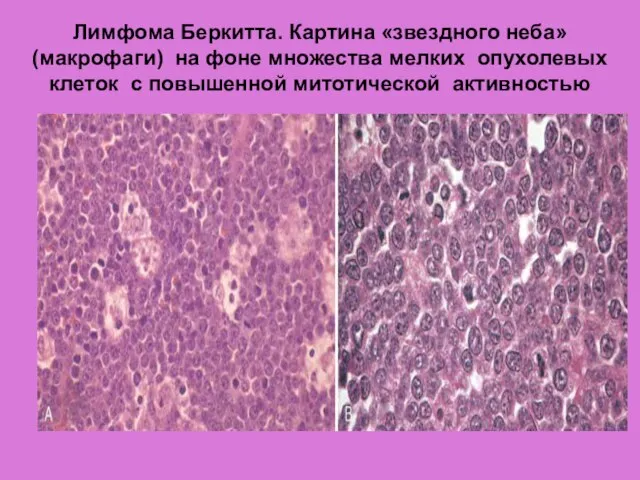 Лимфома Беркитта. Картина «звездного неба» (макрофаги) на фоне множества мелких опухолевых клеток с повышенной митотической активностью