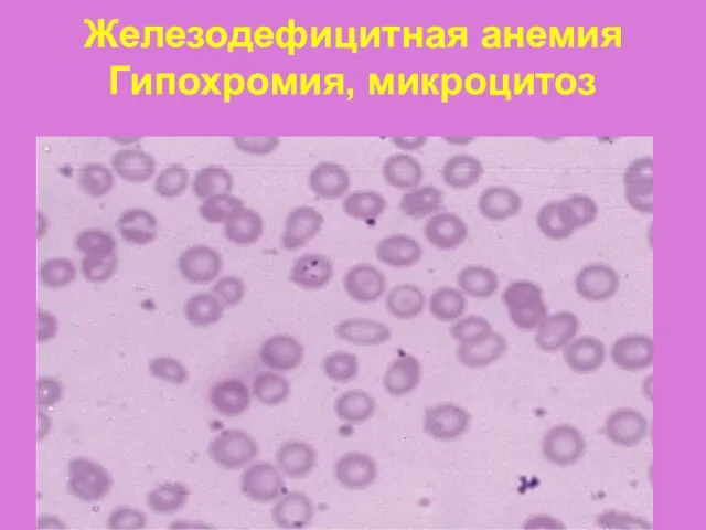 Железодефицитная анемия Гипохромия, микроцитоз