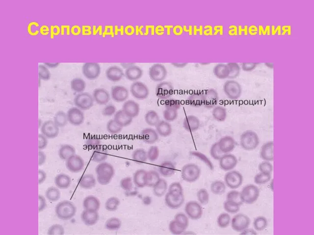 Серповидноклеточная анемия