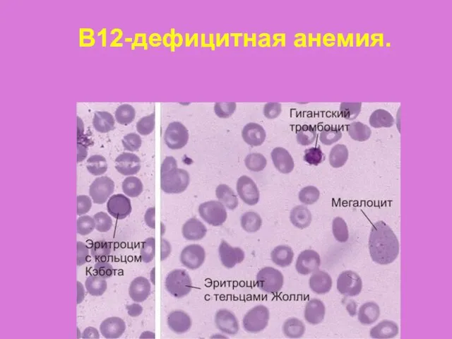 В12-дефицитная анемия.