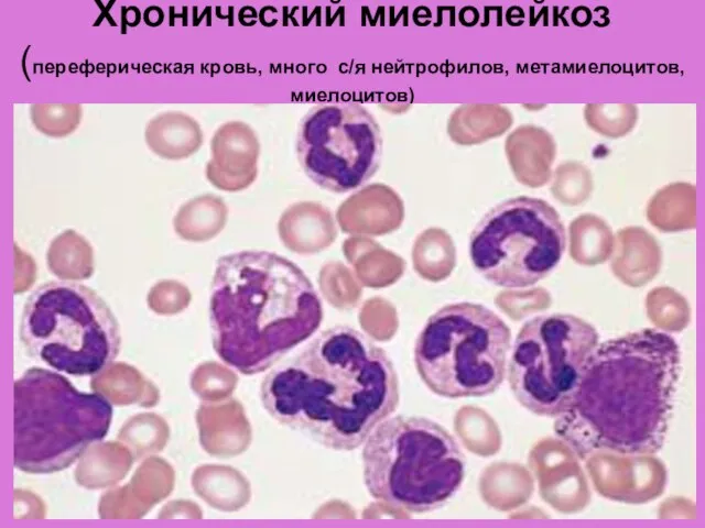 Хронический миелолейкоз (переферическая кровь, много с/я нейтрофилов, метамиелоцитов, миелоцитов)