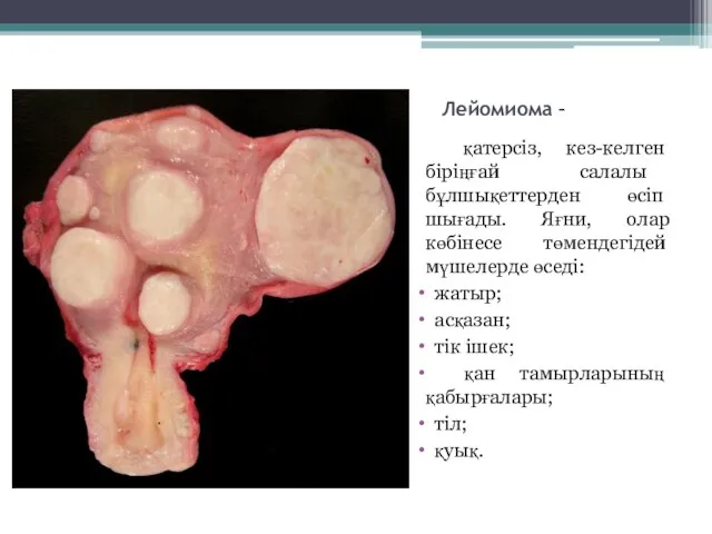 Лейомиома – қатерсіз, кез-келген біріңғай салалы бұлшықеттерден өсіп шығады. Яғни, олар көбінесе
