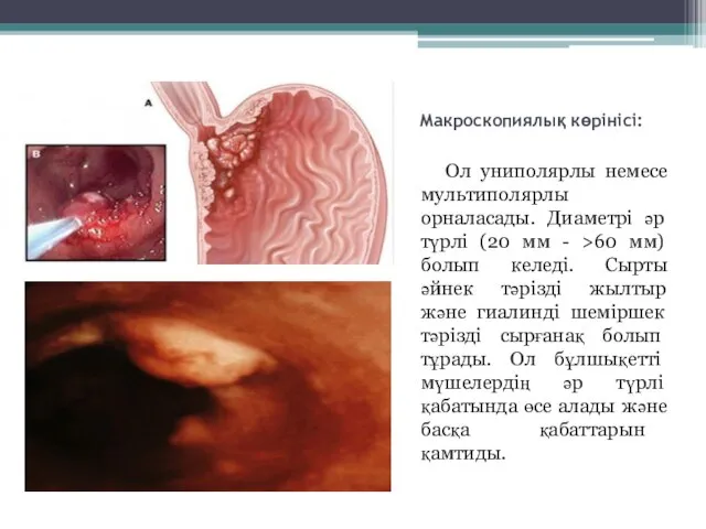 Макроскопиялық көрінісі: Ол униполярлы немесе мультиполярлы орналасады. Диаметрі әр түрлі (20 мм