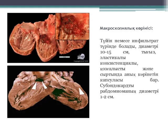 Макроскопиялық көрінісі: Түйін немесе инфильтрат түрінде болады, диаметрі 10-15 см, тығыз, эластикалы