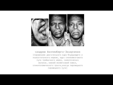 синдром Валленберга-Захарченко (поражением двигательного ядра блуждающего и языкоглоточного нервов, ядра спинномозгового пути