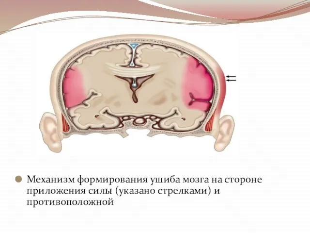 Механизм формирования ушиба мозга на стороне приложения силы (указано стрелками) и противоположной