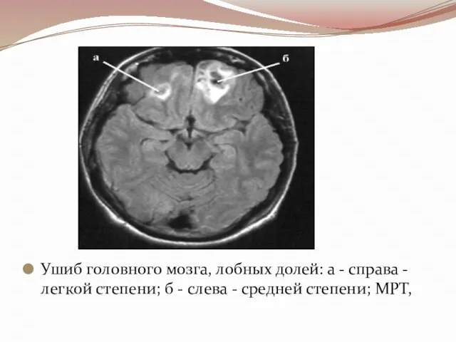 Ушиб головного мозга, лобных долей: а - справа - легкой степени; б
