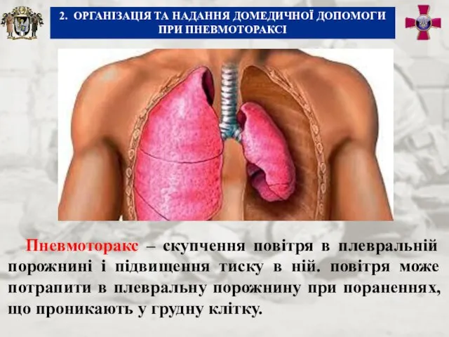 Пневмоторакс – скупчення повітря в плевральній порожнині і підвищення тиску в ній.