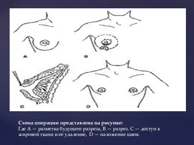 Схема операции представлена на рисунке: Где А — разметка будущего разреза, В