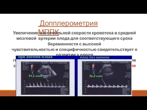 Допплерометрия МППК Увеличение максимальной скорости кровотока в средней мозговой артерии плода для