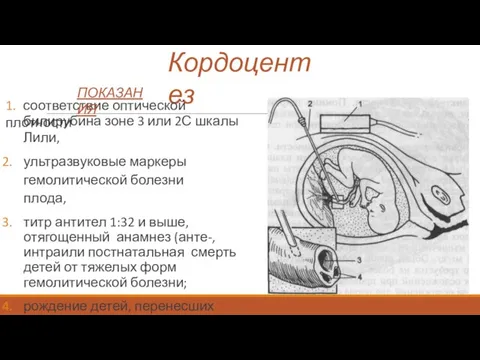 Кордоцентез 1. соответствие оптической плотности билирубина зоне 3 или 2С шкалы Лили,