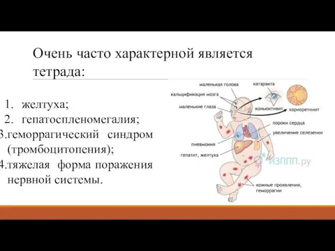 Очень часто характерной является тетрада: желтуха; гепатоспленомегалия; геморрагический синдром (тромбоцитопения); тяжелая форма поражения нервной системы.