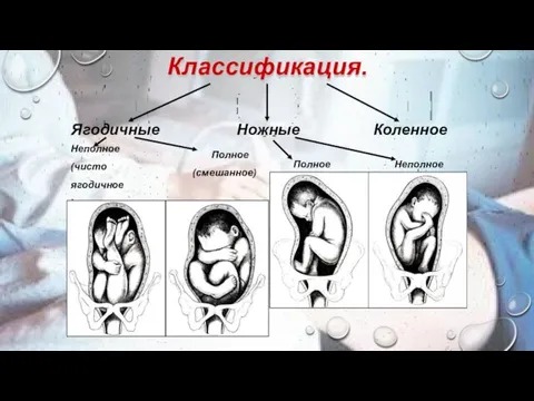 Классификация. Коленное Полное Неполное Ножные Полное (смешанное) Ягодичные Неполное (чисто ягодичное)