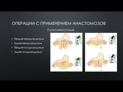 ОПЕРАЦИИ С ПРИМЕНЕНИЕМ АНАСТОМОЗОВ Гастроэнтеростомия Передняя впередиободочная Задняя впередиободочная Передняя позадиободочная Задняя позадиободочная