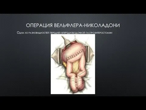 ОПЕРАЦИЯ ВЕЛЬФЛЕРА-НИКОЛАДОНИ Одна из разновидностей передней впередиободочной гастроэнтеростомии