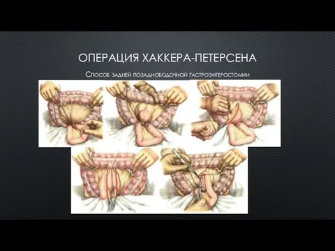 ОПЕРАЦИЯ ХАККЕРА-ПЕТЕРСЕНА Способ задней позадиободочной гастроэнтеростомии