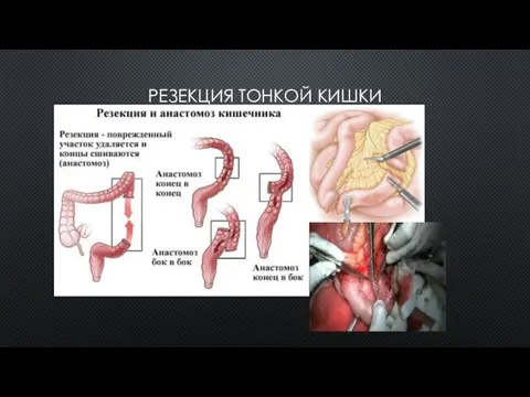 РЕЗЕКЦИЯ ТОНКОЙ КИШКИ