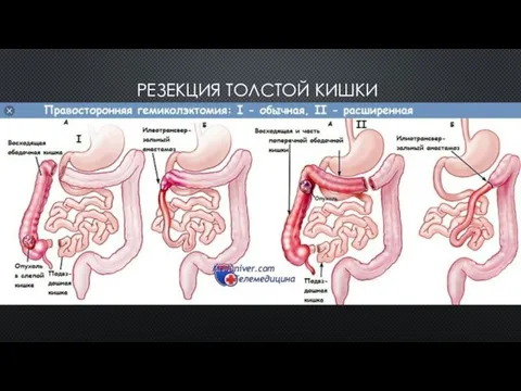 РЕЗЕКЦИЯ ТОЛСТОЙ КИШКИ