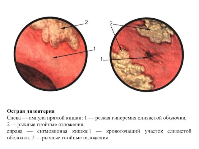 Острая дизентерия Слева — ампула прямой кишки: 1 — резкая гиперемия слизистой