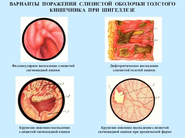 ВАРИАНТЫ ПОРАЖЕНИЯ СЛИЗИСТОЙ ОБОЛОЧКИ ТОЛСТОГО КИШЕЧНИКА ПРИ ШИГЕЛЛЕЗЕ Фолликулярное воспаление слизистой сигмовидной