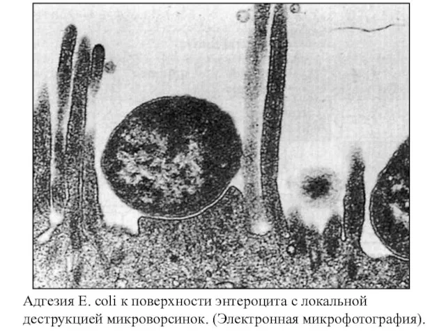 Адгезия E. coli к поверхности энтероцита с локальной деструкцией микроворсинок. (Электронная микрофотография).