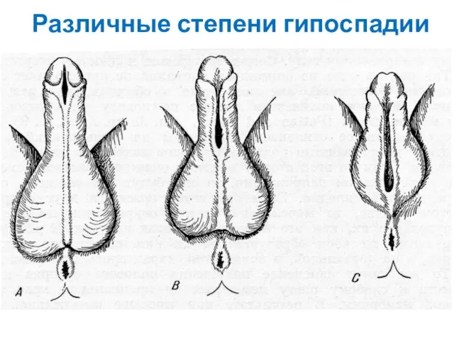 Различные степени гипоспадии