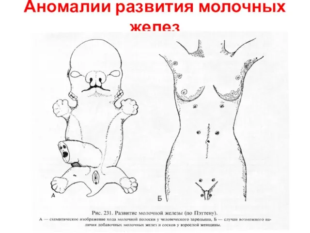 Аномалии развития молочных желез