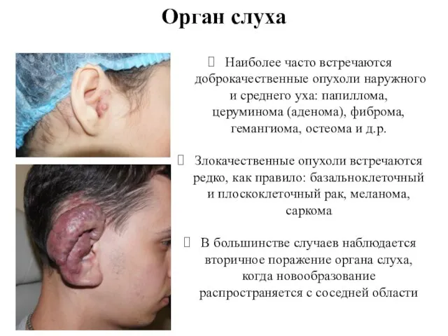 Орган слуха Наиболее часто встречаются доброкачественные опухоли наружного и среднего уха: папиллома,