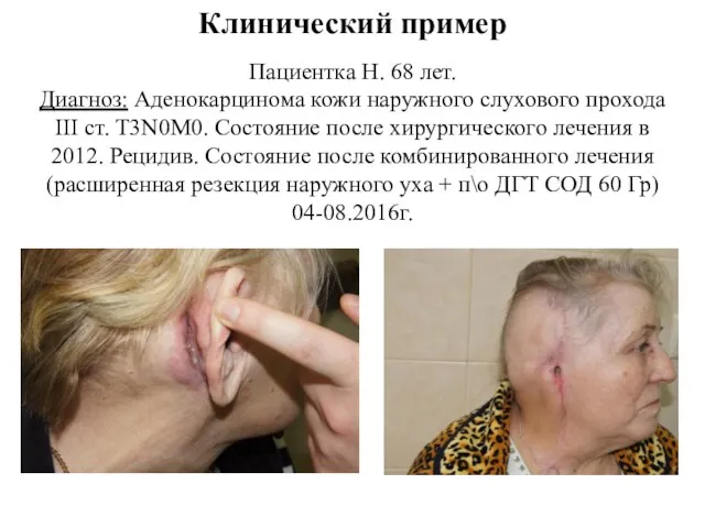 Клинический пример Пациентка Н. 68 лет. Диагноз: Аденокарцинома кожи наружного слухового прохода
